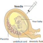 Diagram of amniocentesis